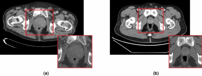 prostatitis diagnosis ct scan)