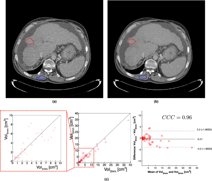 Robustness of radiomic features in CT images with different slice
