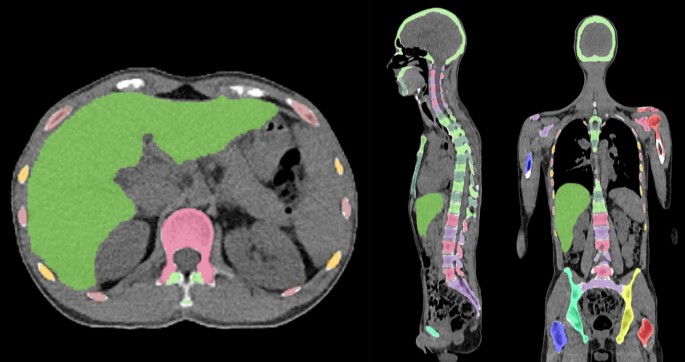 Artificial intelligence could alert for focal skeleton/bone marrow uptake in hodgkin’s lymphoma patients staged with fdg-pet/ct