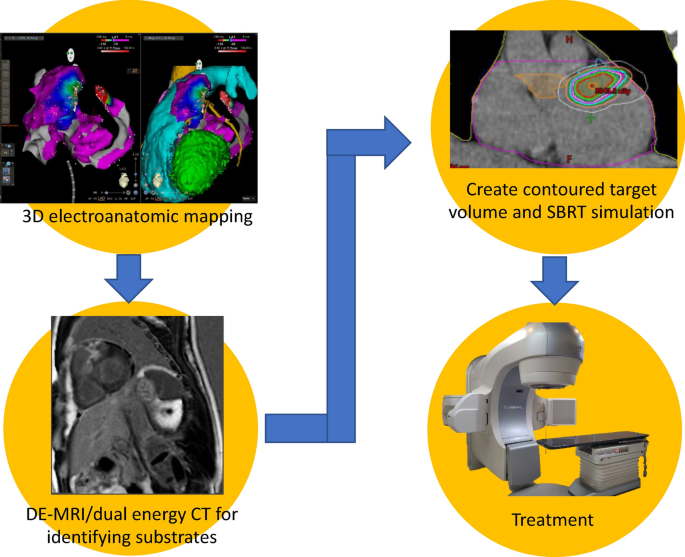 First Asian population study of stereotactic body radiation therapy for  ventricular arrhythmias | Scientific Reports