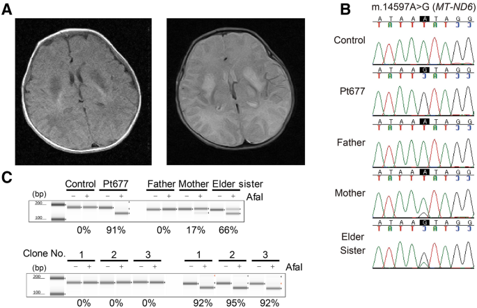 A high mutation load of m. 14597a>g in mt-nd6 causes leigh syndrome