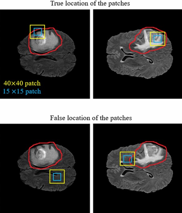 Brain tumor segmentation based on deep learning and an attention mechanism  using MRI multi-modalities brain images