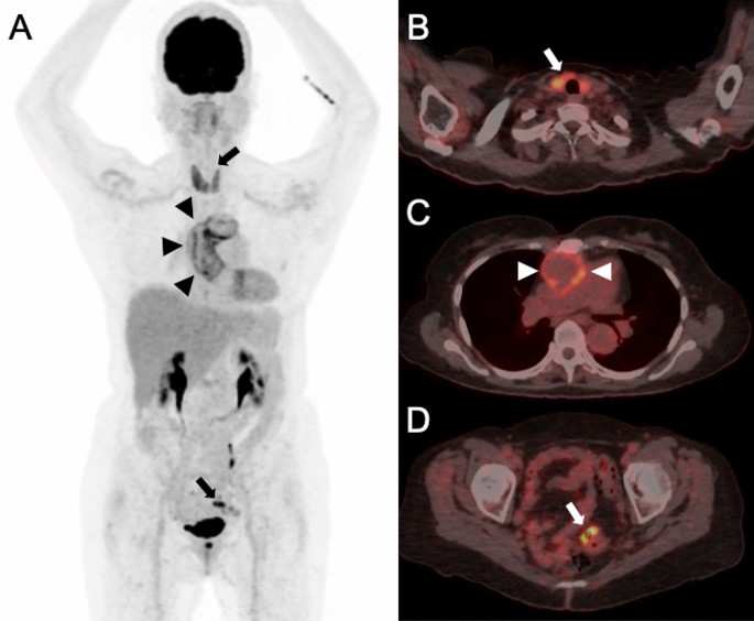 Interstitial Cystitis—Epidemiology - Hanno | HBS