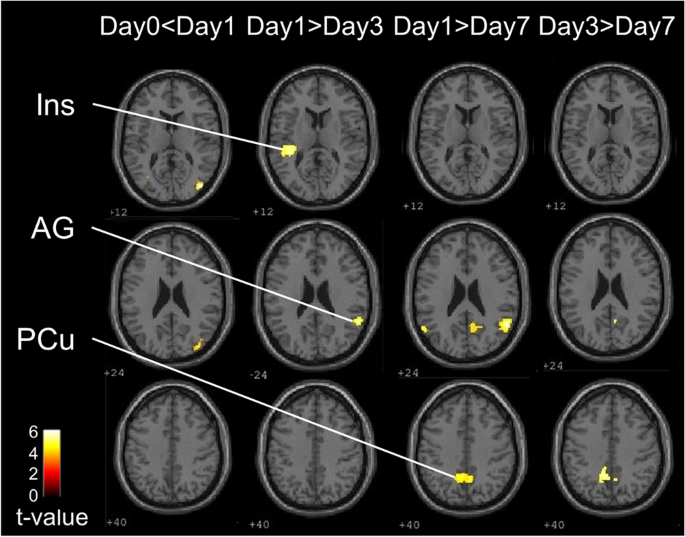 Adaptive brain activity changes during tongue movement with palatal  coverage from fMRI data | Scientific Reports