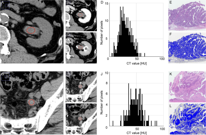 Tumor heterogeneity evaluated by computed tomography detects muscle-invasive upper tract urothelial carcinoma that is associated with inflammatory tum