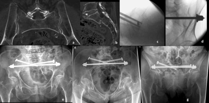 Occult fractures of the proximal femur: imaging diagnosis and management of  82 cases in a regional trauma center | World Journal of Emergency Surgery |  Full Text