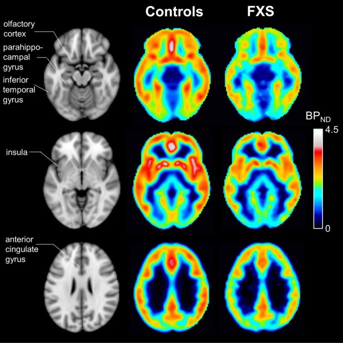 In vivo imaging of mGlu5 receptor expression in humans with Fragile X Syndrome towards development o