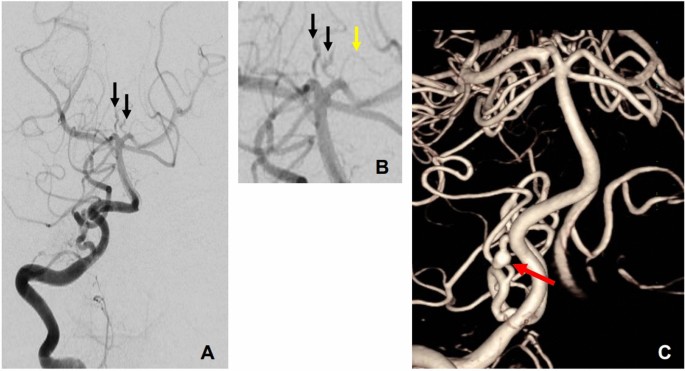 Identification of de novo EP300 and PLAU variants in a patient with  Rubinstein–Taybi syndrome-related arterial vasculopathy and skeletal  anomaly