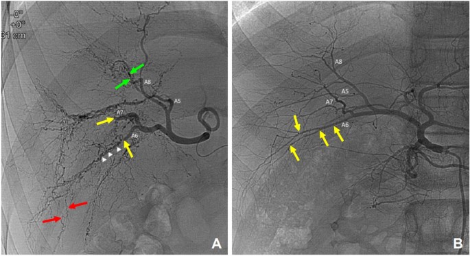 PDF) Identification of de novo EP300 and PLAU variants in a