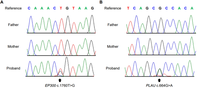 (PDF) Identification of de novo EP300 and PLAU variants in a patient with  Rubinstein–Taybi syndrome-related arterial vasculopathy and skeletal anomaly