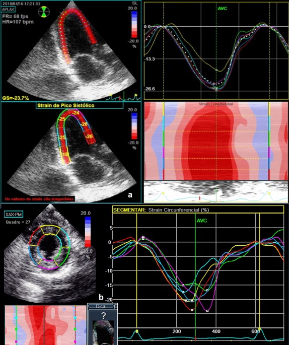 Speckle-Tracking Echocardiography Predicts Adverse Left Ventricular Re