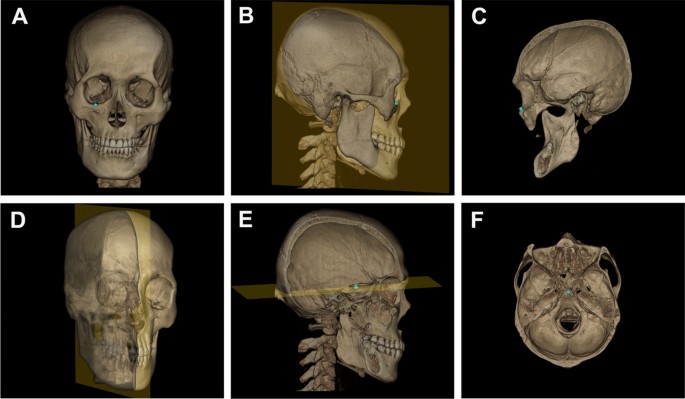 3d Cephalometric Landmark Detection By Multiple Stage Deep Reinforcement Learning Scientific Reports