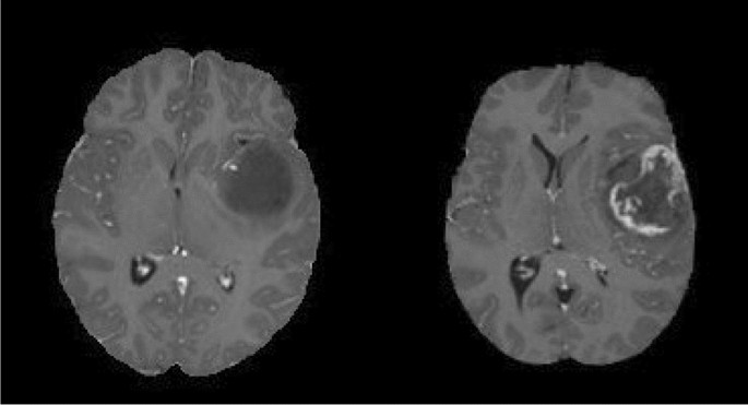 brain scan with tumor