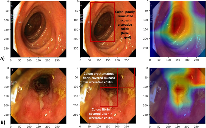 Characteristic endoscopic findings of ulcerative colitis complicated by