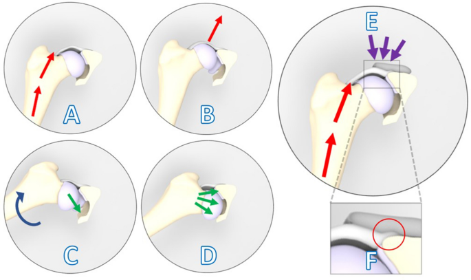 Patient-specific 3D-printed shelf implant for the treatment of hip 