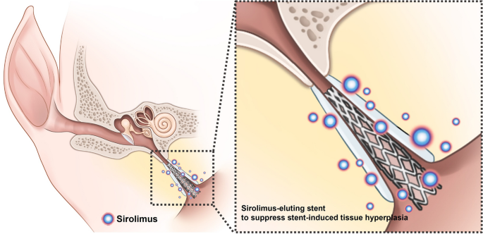 Sirolimus-eluting cobalt–chrome alloy stent suppresses stent-induced tissue hyperplasia in a porcine eustachian tube model