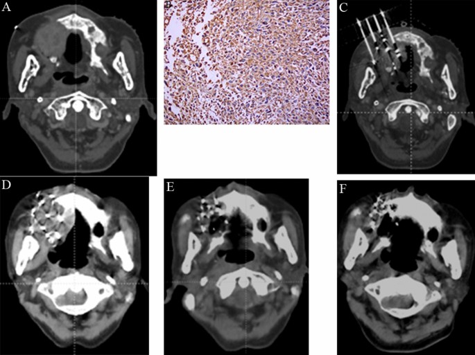Evaluation of the efficacy of CT-guided 3D template-assisted 125I 
