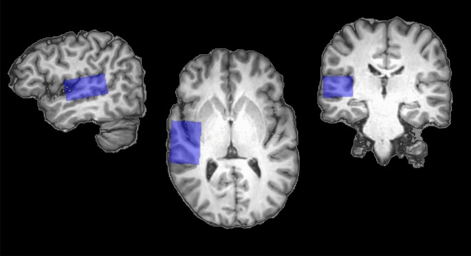 glutathione tinnitu Lower glutamate and GABA levels in auditory cortex of tinnitus patients: a 2D-JPRESS MR spectroscopy study Tinnitus Treatment: What Works, What