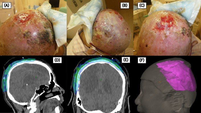 Prognostic factor analysis of definitive radiotherapy using  intensity-modulated radiation therapy and volumetric modulated arc therapy  with boluses for scalp angiosarcomas | Scientific Reports