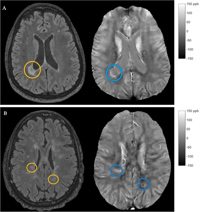 Disease correlates of rim lesions on quantitative susceptibility mapping in multiple  sclerosis | Scientific Reports