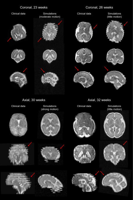Hyperecho-Turbo Spin-Echo Sequences at 3T: Clinical Application in  Neuroradiology
