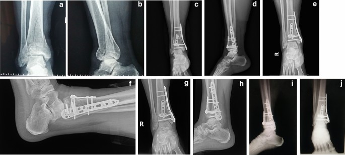 Distal Tibia Plate Surgical Technique