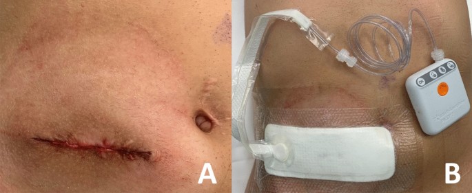 Closed-wound negative pressure therapy dressing after loop ostomy closure:  a retrospective comparative study