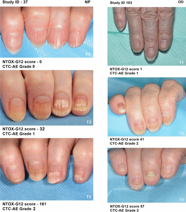 Is Cancer Treatment Affecting Your Skin and Nails?