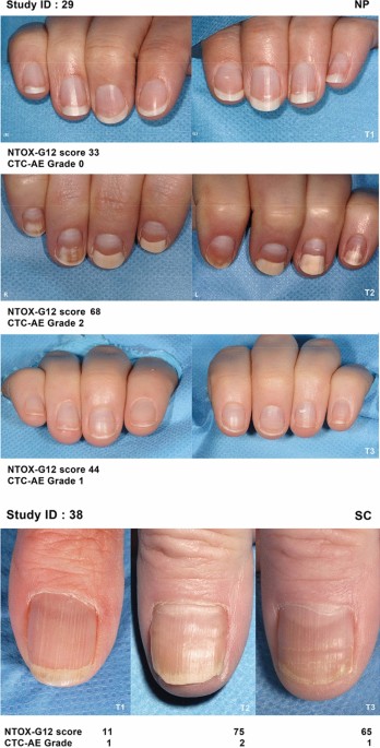 PDF) Study of Nail Disorders in Dermatology