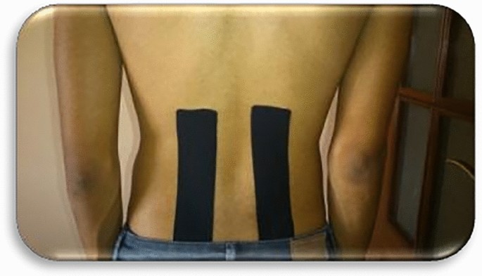Kinesio tape application. (A) With tension (stabilizing effect): 2