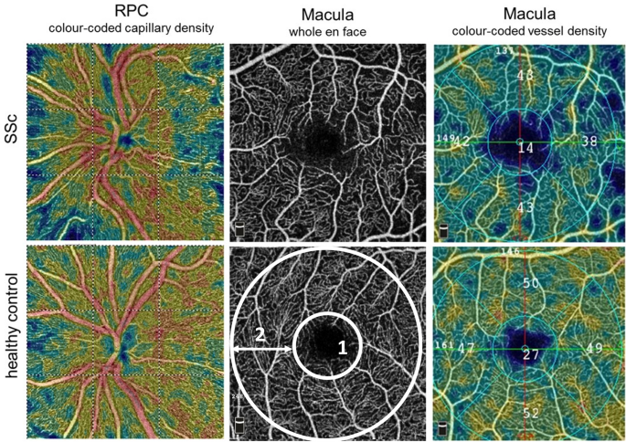 Altered ocular microvasculature in patients with systemic sclerosis and  very early disease of systemic sclerosis using optical coherence tomography  angiography