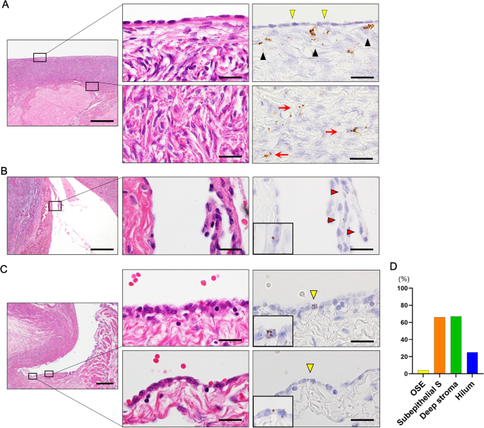 Differential epithelial and stromal LGR5 expression in ovarian carcinogenesis