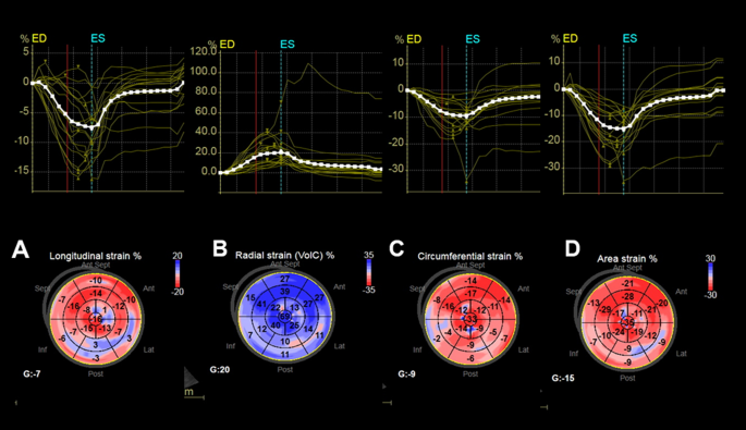 Speckle tracking echocardiography illustrating global longitudinal