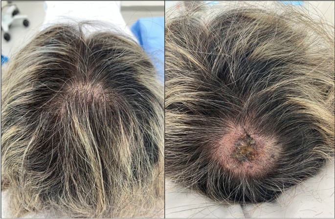 A cross-sectional study of clinical, dermoscopic, histopathological, and  molecular patterns of scalp melanoma in patients with or without  androgenetic alopecia | Scientific Reports