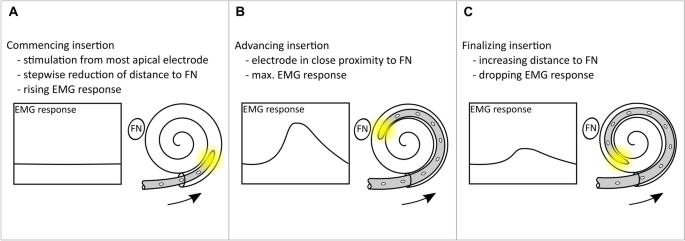 Application of intentional facial nerve stimulation during cochlear  implantation as an electrophysiological tool to estimate the intracochlear  electrode position | Scientific Reports