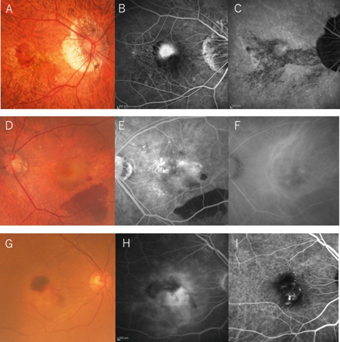 Characteristics of choroidal neovascularization in elderly eyes with high myopia not meeting the pathologic myopia definition - Scientific Reports