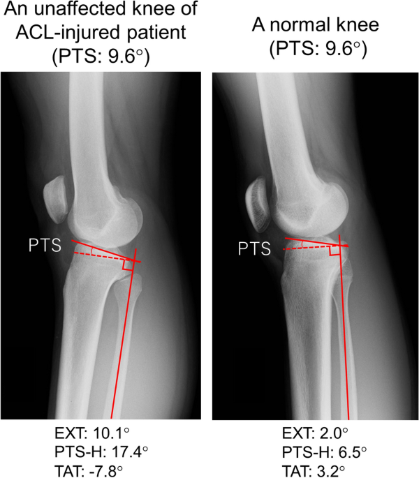 Influence of posterior tibial slope on sagittal knee alignment with  comparing contralateral knees of anterior cruciate ligament injured  patients to healthy knees | Scientific Reports