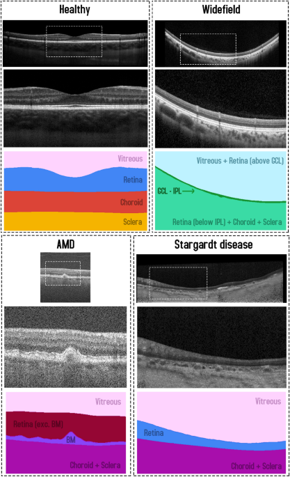 A comparison of deep learning U-Net architectures for posterior segment OCT retinal layer segmentation