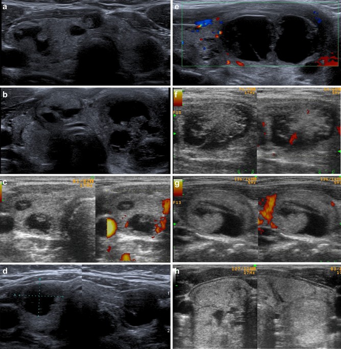 Ultrasound features of multinodular goiter in DICER1 syndrome