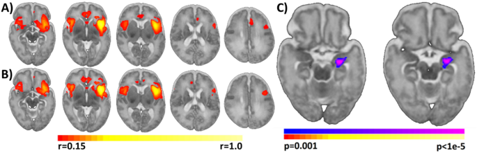 Hypoconnectivity between anterior insula and amygdala associates ... - Nature.com