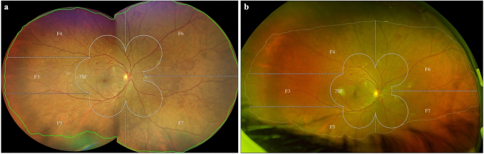 Comparison of two ultra-widefield color-fundus imaging devices for visualization of retinal periphery and microvascular lesions in patients with early diabetic retinopathy | Scientific Reports