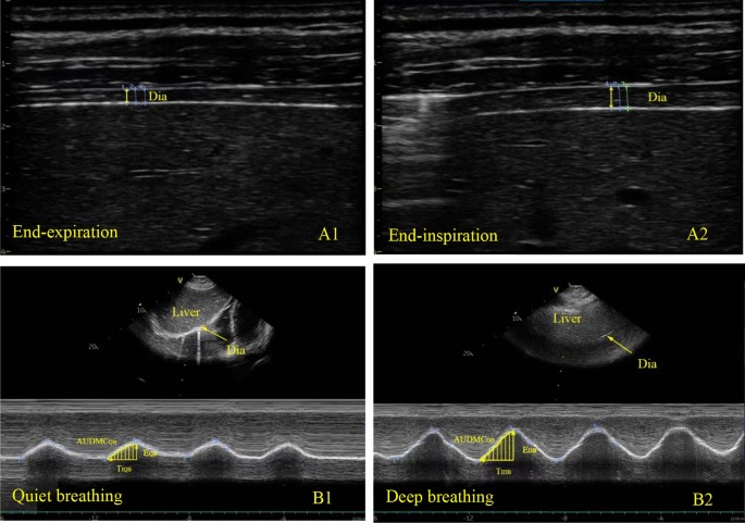 Quantification of diaphragmatic dynamic dysfunction in septic patients by bedside ultrasound | Scientific Reports