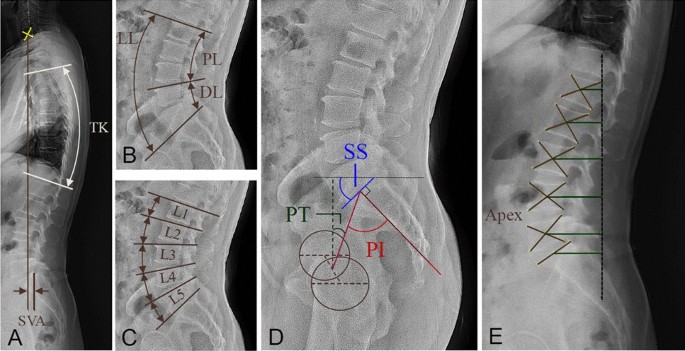 How to really assess lumbar lordosis - Dispelling the myth of anterior  pelvic tilt - MSK Neurology