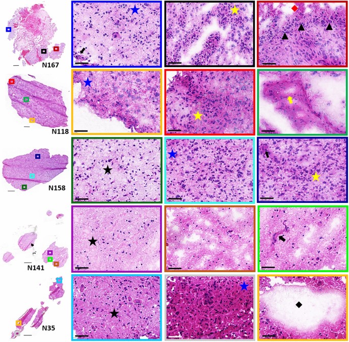 Mass spectrometry imaging discriminates glioblastoma tumor cell subpopulations and different microvascular formations based on their lipid profiles | Scientific Reports