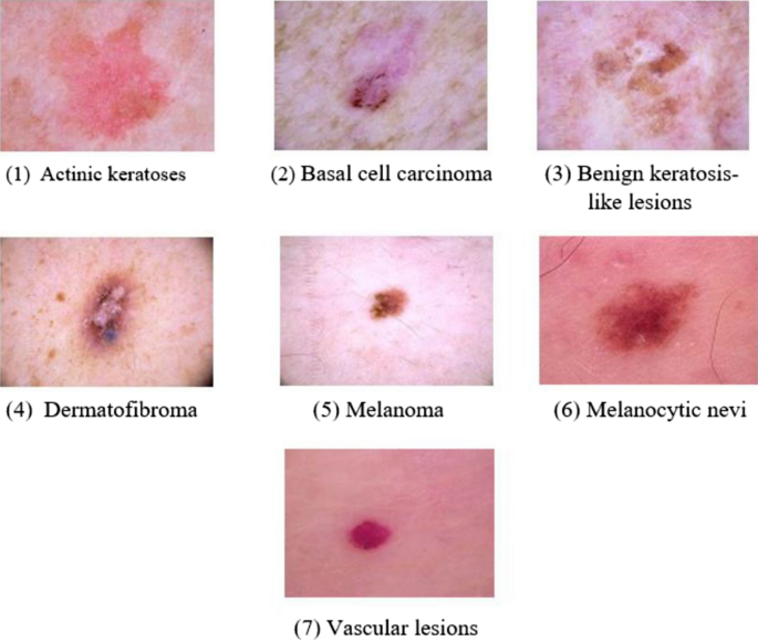 Skin lesion classification of dermoscopic images using machine learning and  convolutional neural network | Scientific Reports
