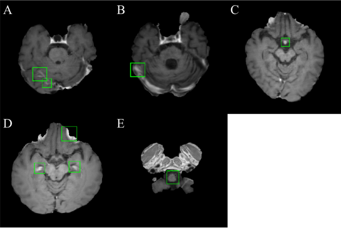 Automated detection of brain metastases on non-enhanced CT using