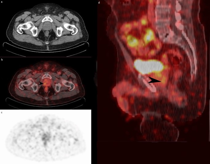 68Ga-PSMA PET/CT in early relapsed prostate cancer patients after radical  therapy | Scientific Reports