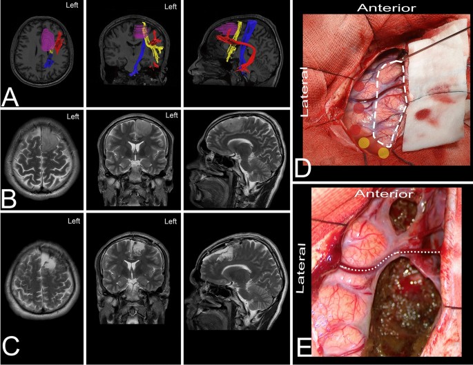 Cortical and white matter anatomy relevant for the lateral and superior  approaches to resect intraaxial lesions within the frontal lobe