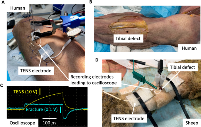 Electrical stimulation in bone tissue engineering treatments