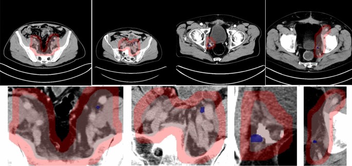 18F-fluciclovine-PET/CT imaging versus conventional imaging alone to guide  postprostatectomy salvage radiotherapy for prostate cancer (EMPIRE-1): a  single centre, open-label, phase 2/3 randomised controlled trial - The  Lancet